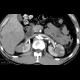 Polyarteritis nodosa: CT - Computed tomography